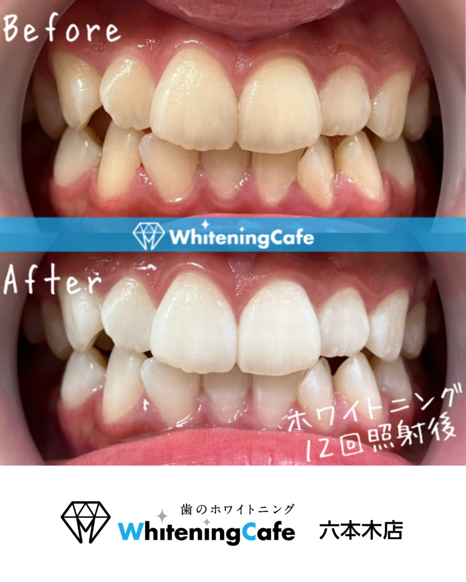 【ホワイトニングカフェ六本木店】照射before、after写真