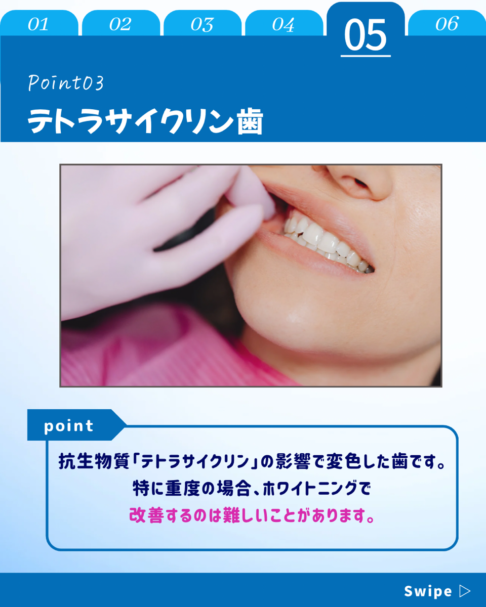 【ホワイトニングカフェ六本木店】効果が出やすい歯の特徴とは？
