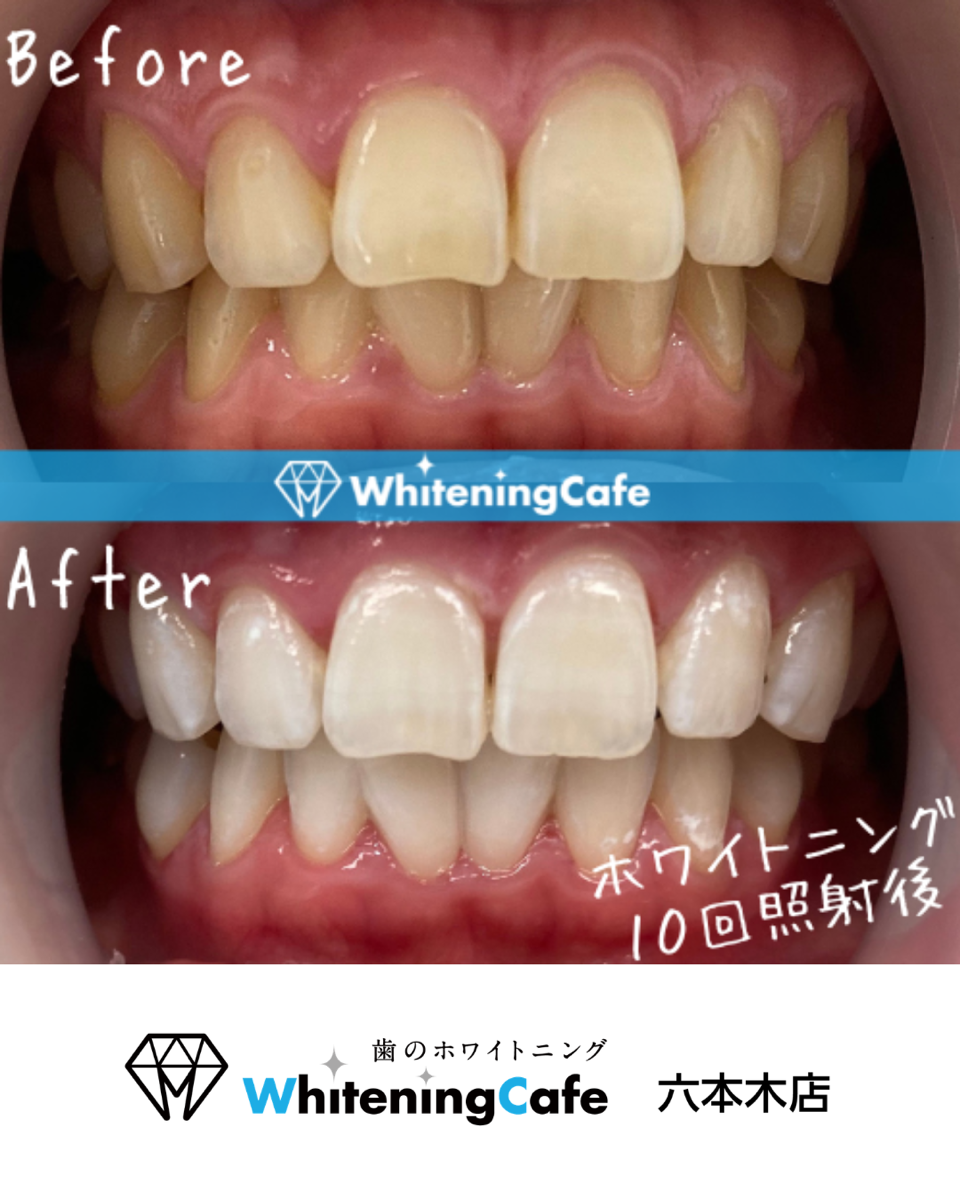 【ホワイトニングカフェ六本木店】照射before、after写真