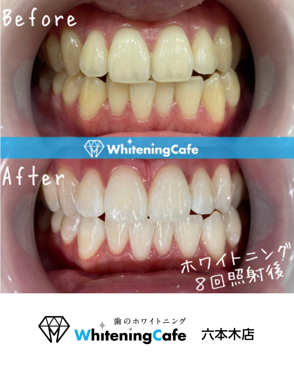 【ホワイトニングカフェ六本木店】照射before、after写真✨