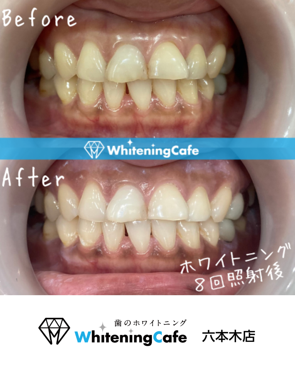 【ホワイトニングカフェ六本木店】照射before、after写真☆