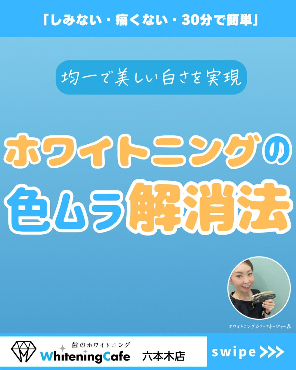 【ホワイトニングカフェ六本木店】ホワイトニング後「色ムラ」になった経験は❓