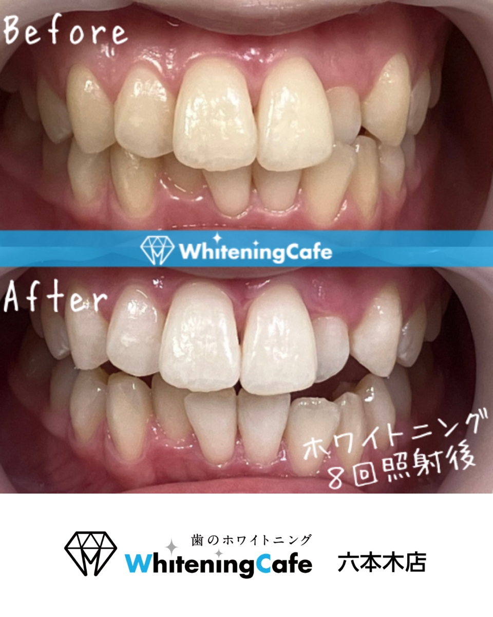 【ホワイトニングカフェ六本木店】☆照射before、after写真☆