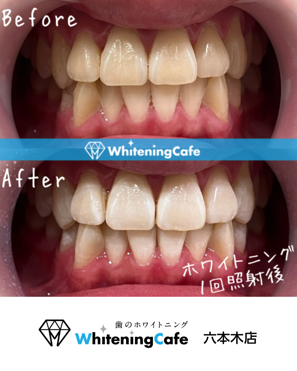 【ホワイトニングカフェ六本木店】ホワイトニング照射before、after写真🦷✨