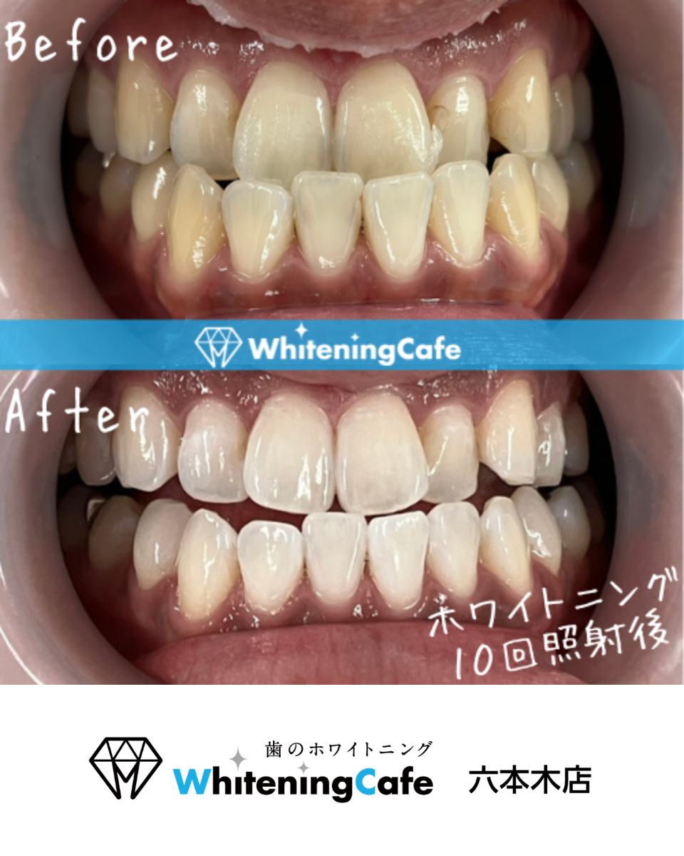 【ホワイトニングカフェ六本木店】照射before、after写真