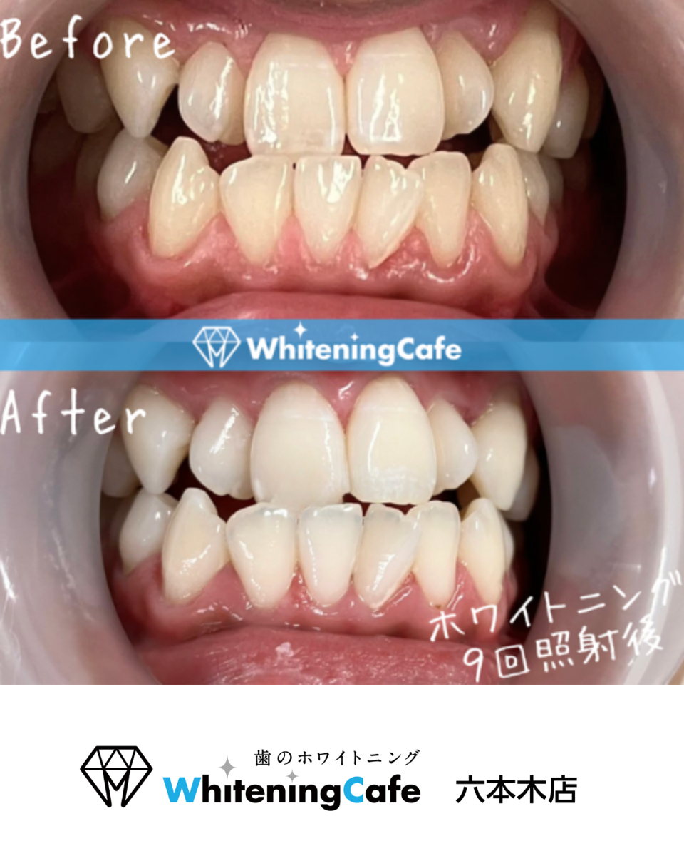 【ホワイトニングカフェ六本木店】☆照射before、after写真☆