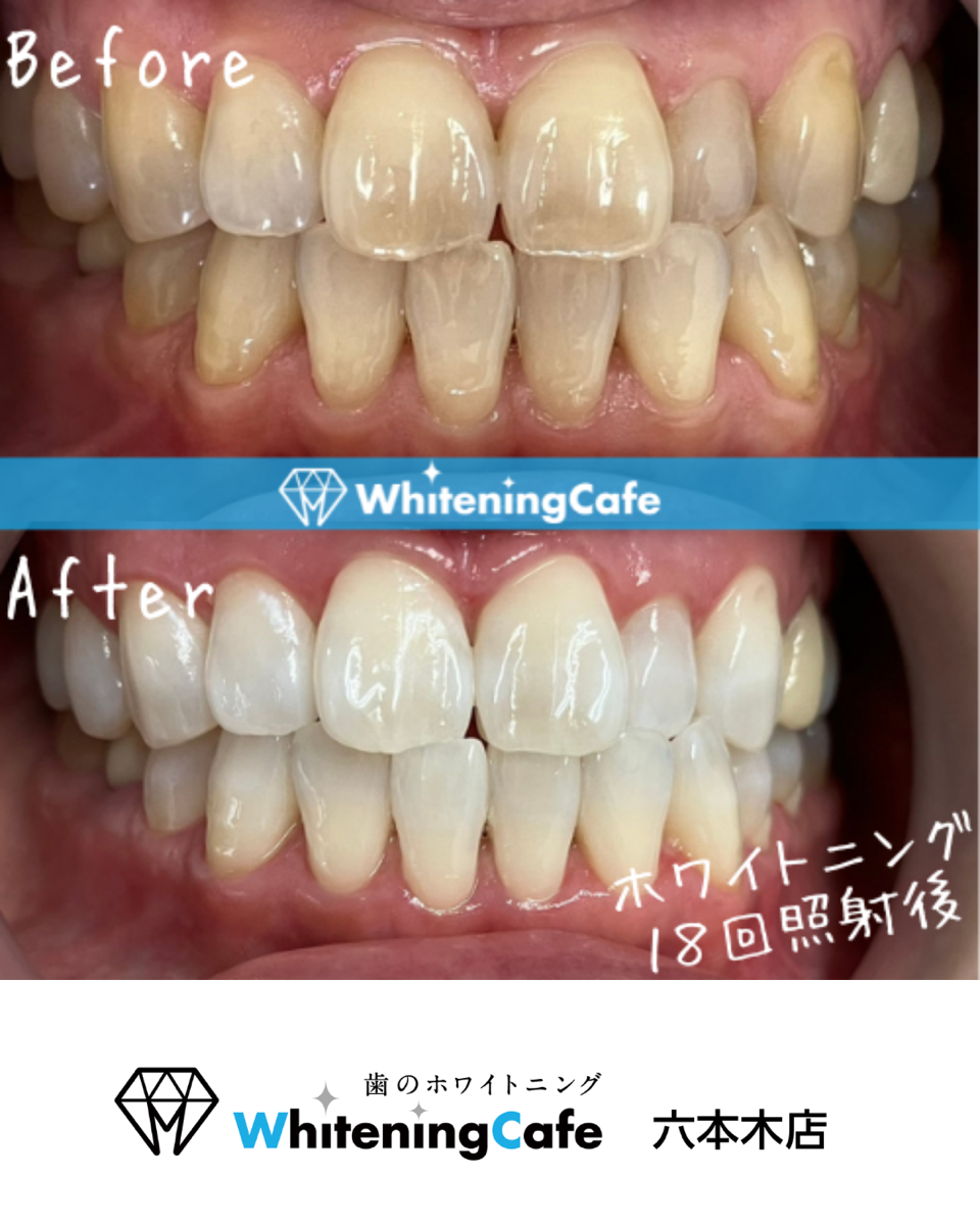 【ホワイトニングカフェ六本木店】照射before、after🦷✨
