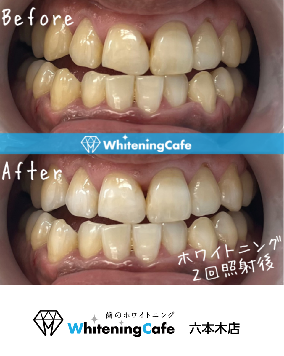 【ホワイトニングカフェ六本木店】照射before、after🦷✨