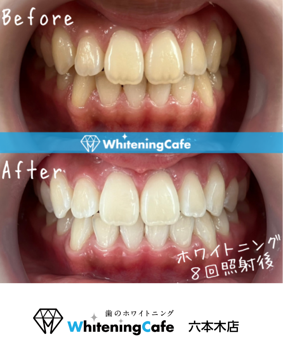 【ホワイトニングカフェ六本木店】照射before、after写真🦷✨