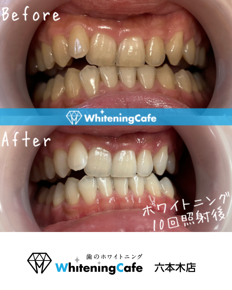 【ホワイトニングカフェ六本木店】照射before、after🦷✨
