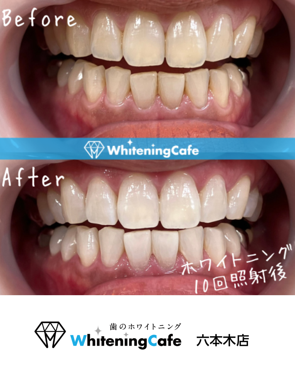 【ホワイトニングカフェ六本木店】照射before、after写真🦷✨