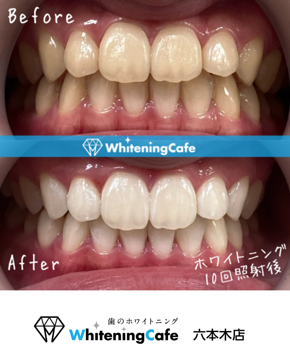 【ホワイトニングカフェ六本木店】照射before、after写真