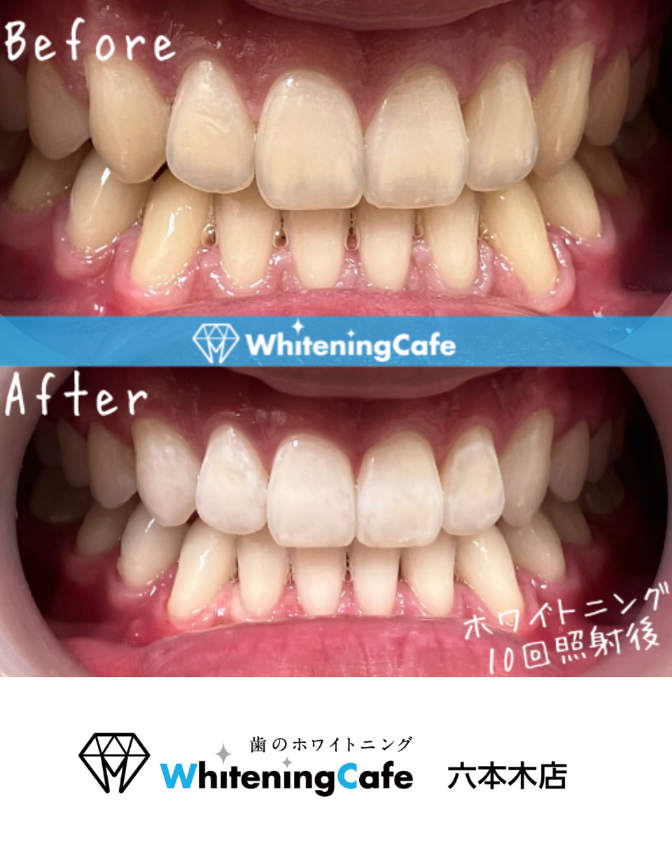 【ホワイトニングカフェ六本木店】照射before、after写真☆