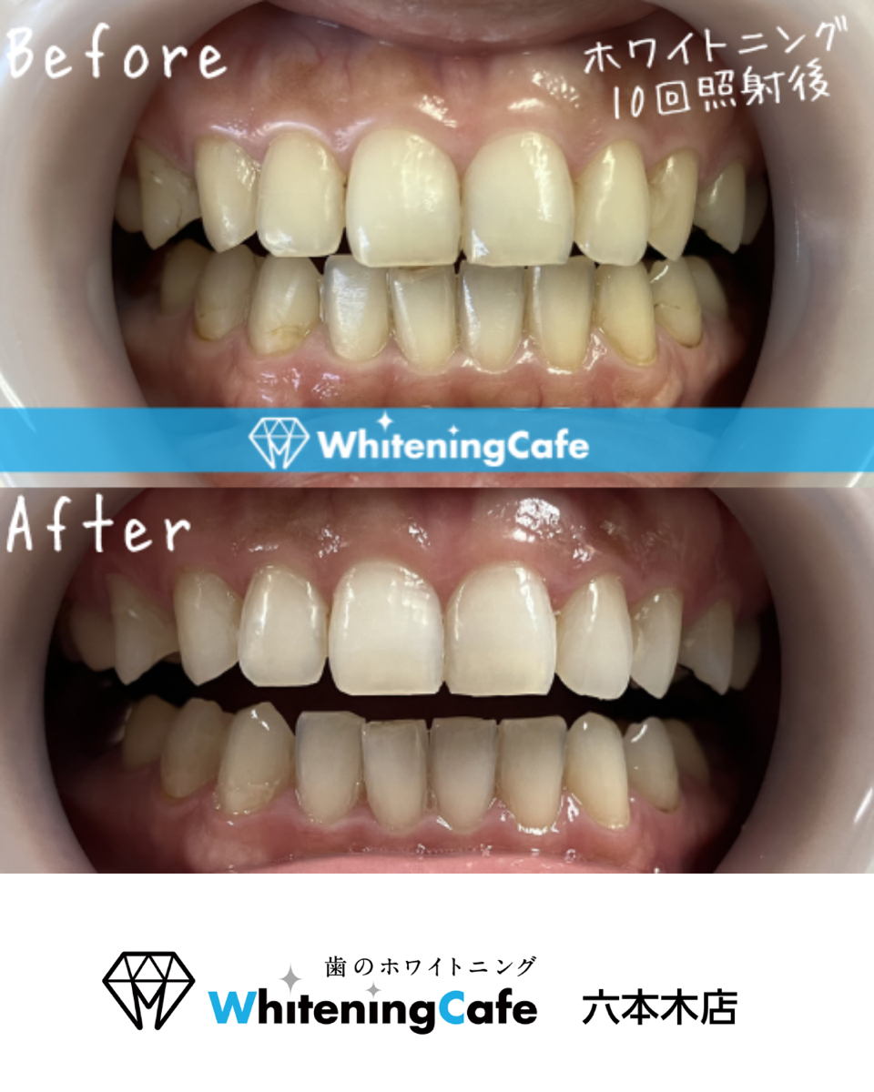 【ホワイトニングカフェ六本木店】10回照射された方のbefore、after写真☆